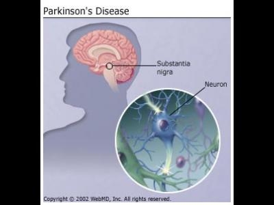 poza despre boala parkinson
